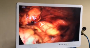 Néphrectomie coelioscopique à TANGANYIKA HOSPITAL